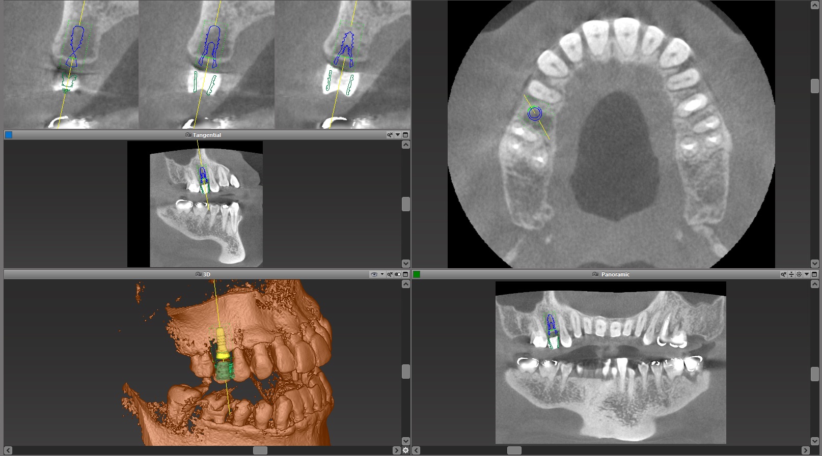 CTによる事前シミュレーションとガイドによる安全なインプラント治療