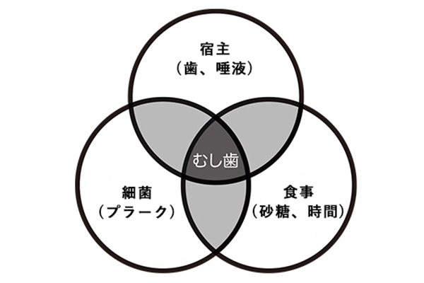 虫歯の原因について