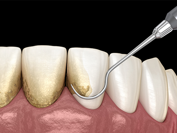 歯と歯肉の間に溜まっていた歯石や歯垢（プラーク）除去