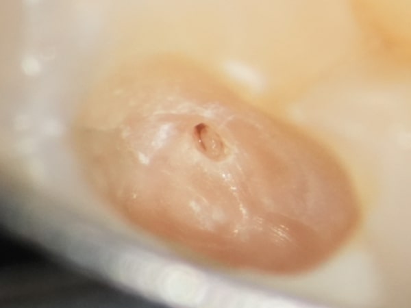 虫歯によって露出した歯髄