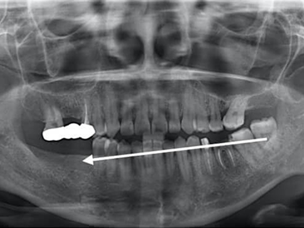 歯牙移植のメリット