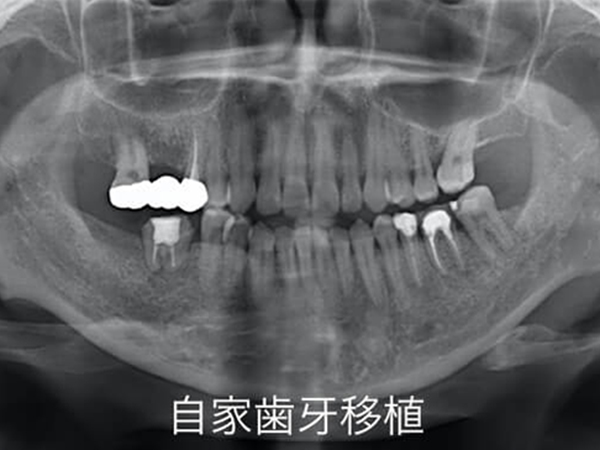 歯牙移植とインプラントの違い