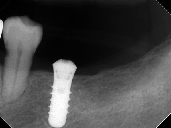 インプラント埋入後のエックス線写真